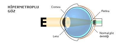 hipermetropi