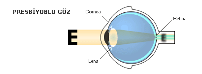 presbiyobili göz